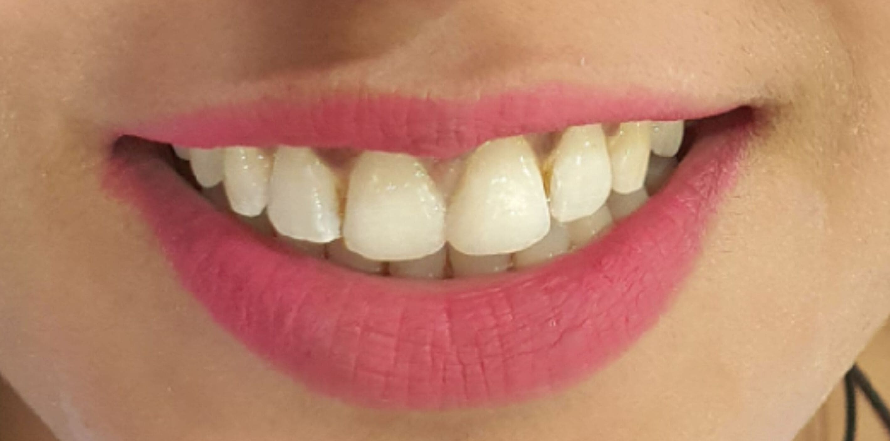 After Dental Esthetics Treatment