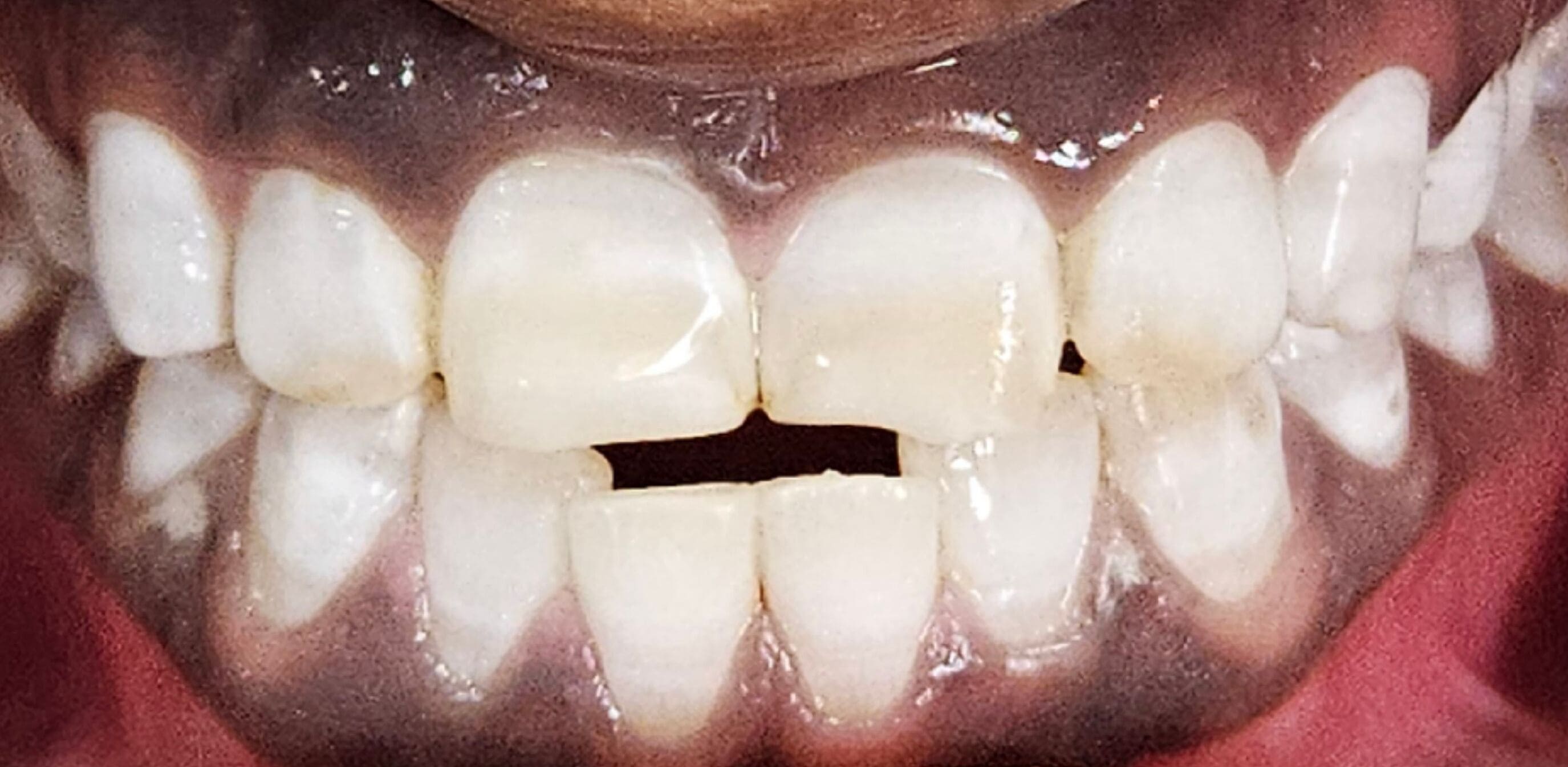 After Tooth Whitening
