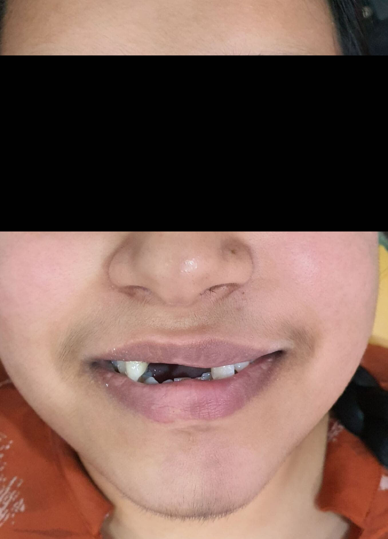 Before Fixed Tooth Treatment