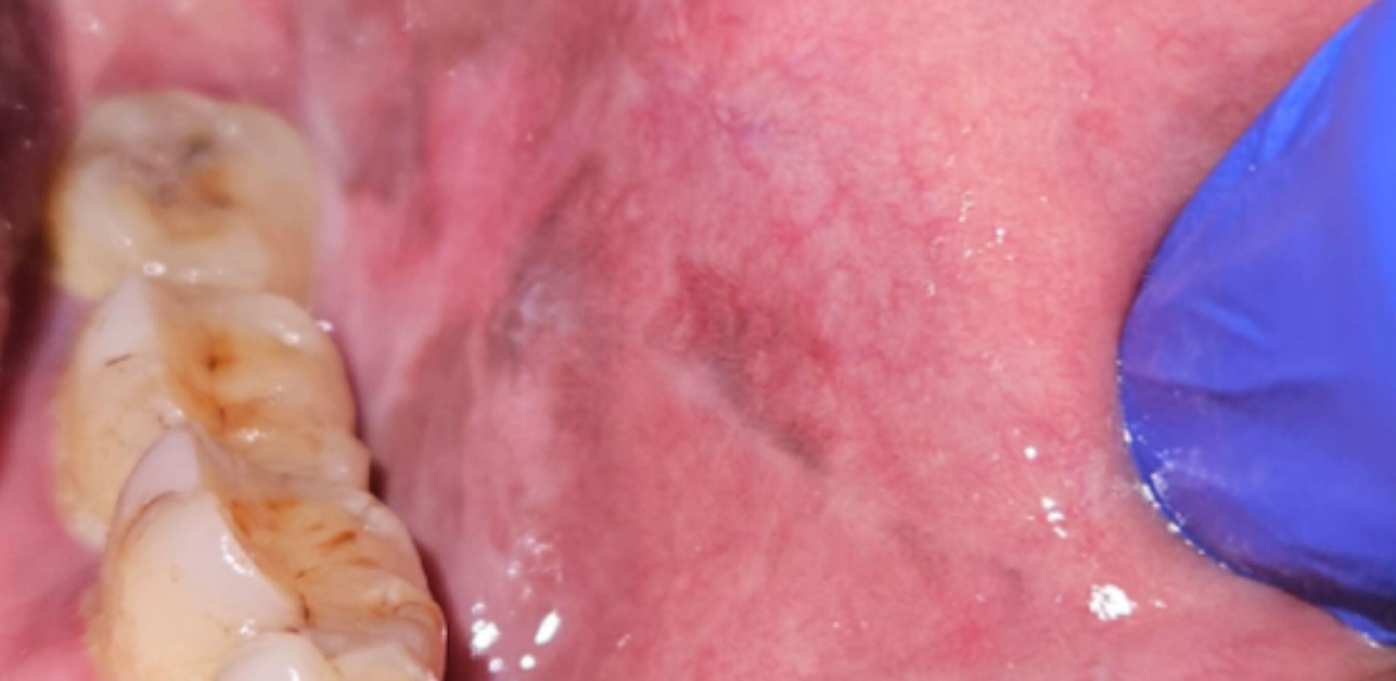 After Gum Treatment