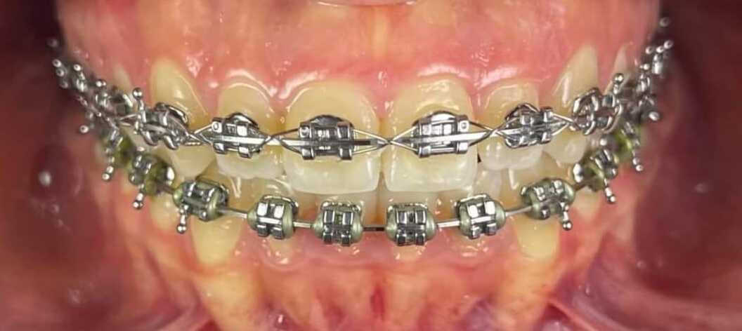 After Braces Treatment