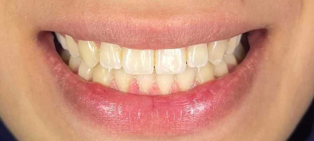 Before Orthodontic Treatment and Aligners