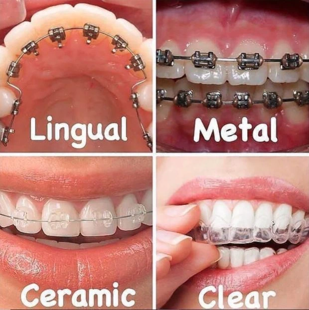 Braces Treatment