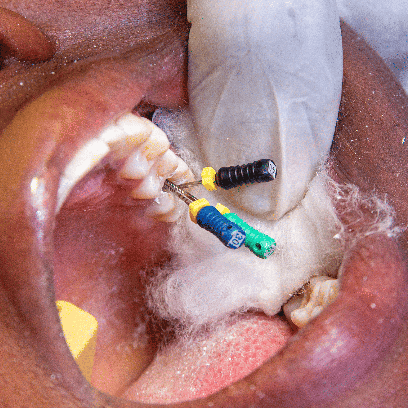 Painless Root Canal